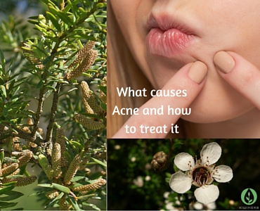 What causes Acne and how to treat it